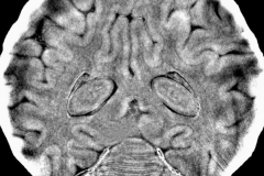 Linda-Croton-X-ray-Phase-Contrast-CT-of-a-Neonatal-Sheep-Brain